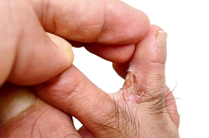 What Causes Athlete’s Foot?