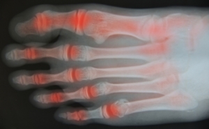 Osteoarthritis and the Feet