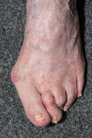 Causes and Symptoms of Bunions