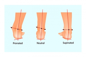 How to Recognize Overpronation