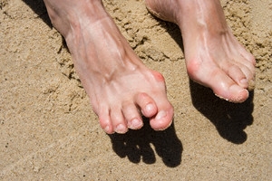 What Is a Hammertoe?