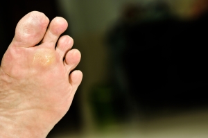 What Are Plantar Warts?