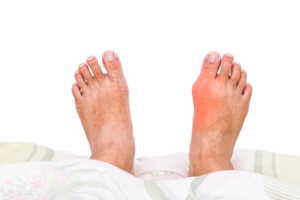 Battling Bony Bunions