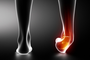 Understanding High Ankle Sprains