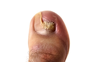 Understanding Toenail Fungus