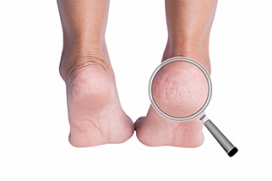 What Is Juvenile Plantar Dermatosis?