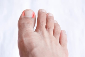 Pain and Ingrown Toenails