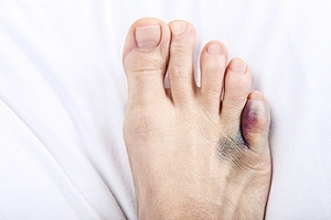 Symptoms and Causes of a Broken Pinky Toe