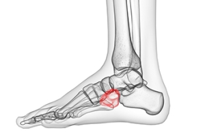 Causes and Diagnosis of Cuboid Syndrome