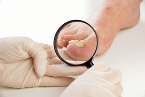 Do Toenail Fungus Treatments Work?