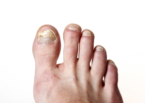 How To Prevent Toenail Fungus