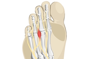 A Common Cause of Morton’s Neuroma