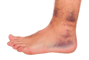 Possible Reasons for Foot and Ankle Trauma