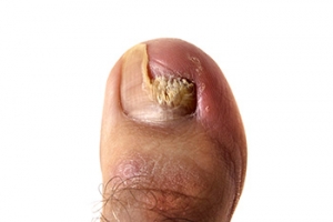 Recurrence of Toenail Fungus