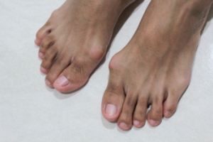 Bunion Relief