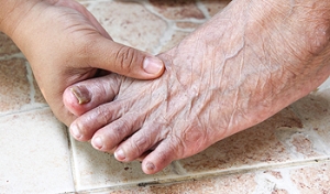 Who Is Susceptible to Toenail Fungus?